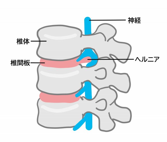 ヘルニア